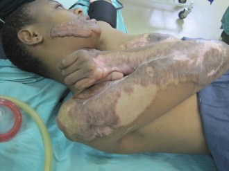 burns contracture (4) copy