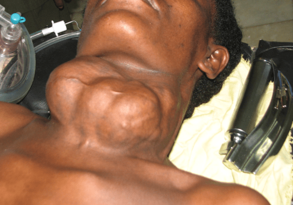 recurrent case thyroid