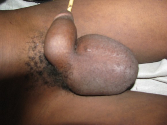 air in male genitals copy