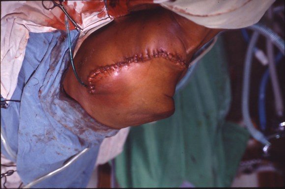 forequrtr amptn copy